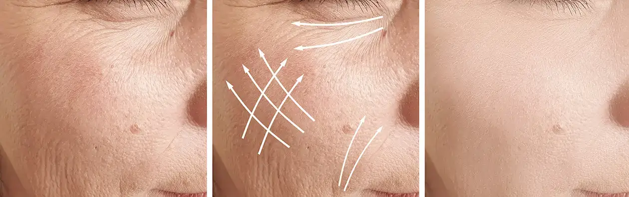 sous-rubrique-injections-anti-rides-2