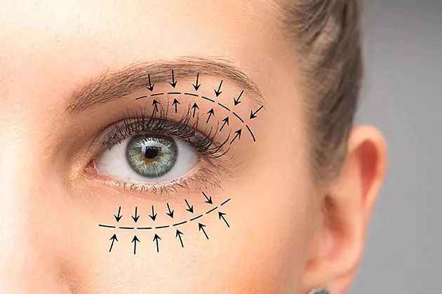 sous-rubrique-blépharoplastie