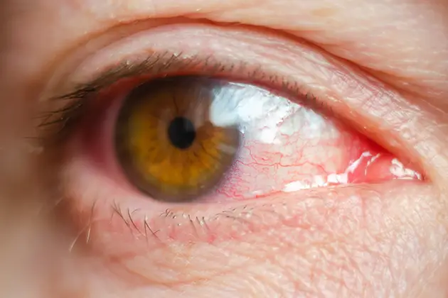 subtítulo-conjuntivitis