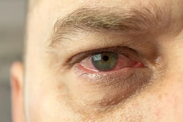 sub-heading-dry-eyes