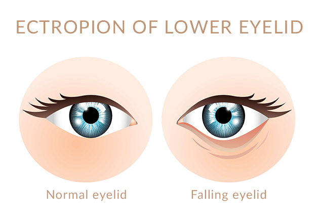 ectropion