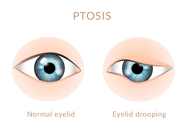 sous-titre-ptosis