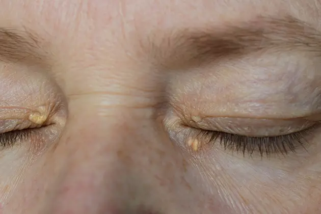 Unterüberschrift-Xanthelasma