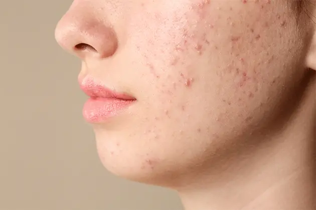 sub-heading-acne