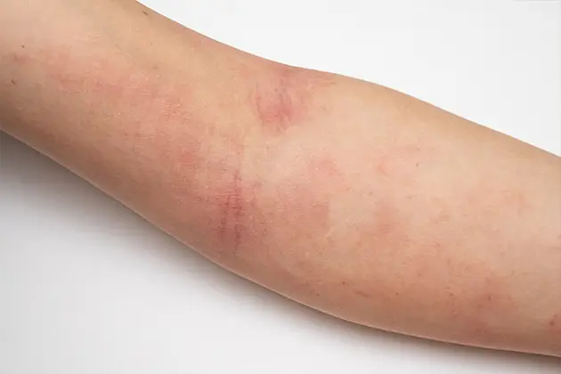 sous-rubrique-eczéma