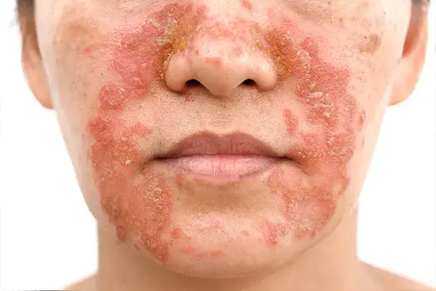 subtítulo-dermatitis-seborreica