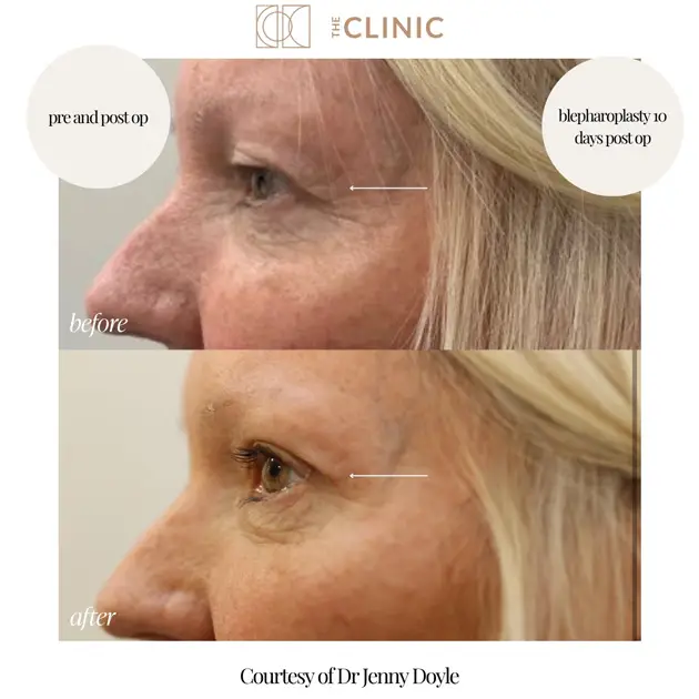 gallery-blepharoplasty-surgery-7-2