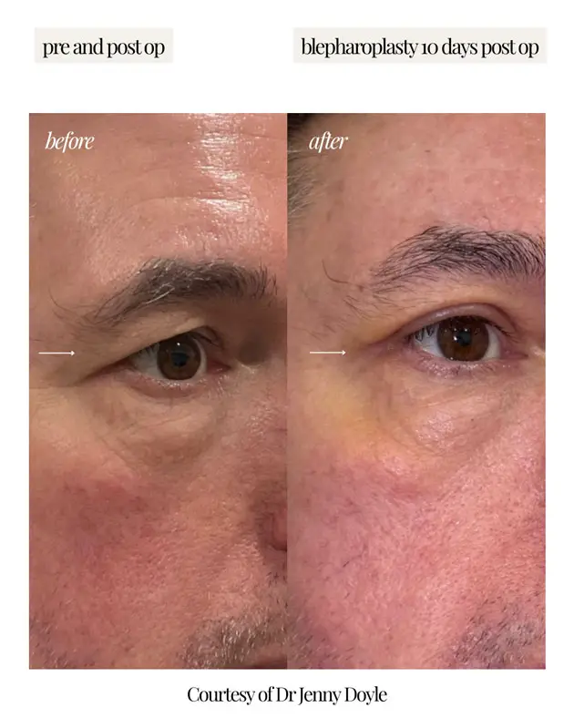 gallery-blepharoplasty-surgery-9-1
