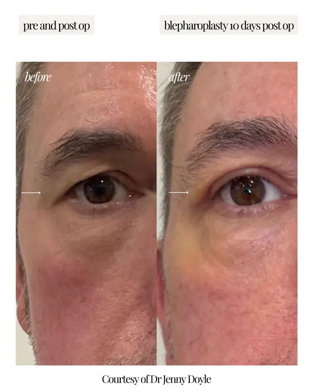 gallery-blepharoplasty-surgery-9-2